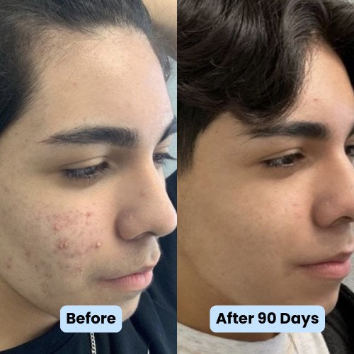 Side profile before and after 90 days on the copper peptide serum