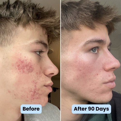 Second before and after side profile after the 90 day protocol