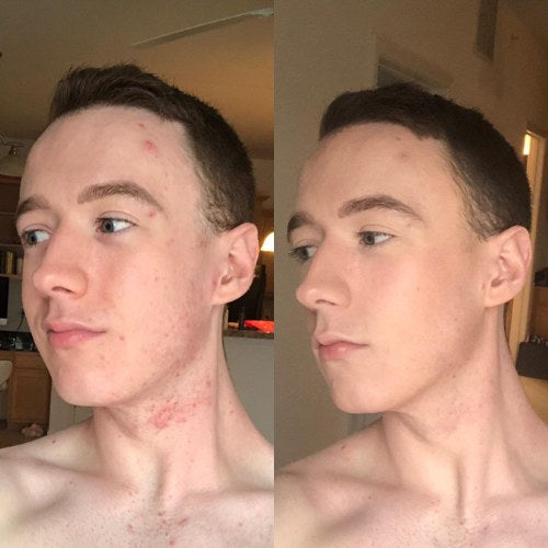 Ethan R. result after 2 months
