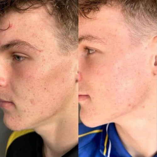 Lucas M. result after 6 weeks